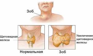 Признаки увеличения щитовидки