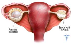Киста на яичнике