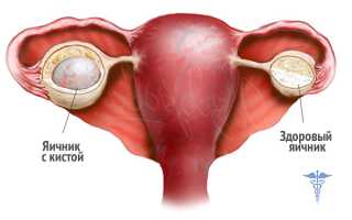 Киста на яичнике