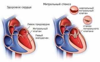Недостаточность или фиброз клапанов сердца: причины и помощь больному