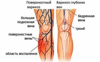 Как выявляется и лечится клапанная недостаточность вен