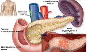 Воспаление поджелудочной железы