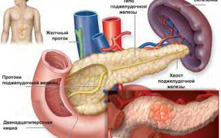 Воспаление поджелудочной железы