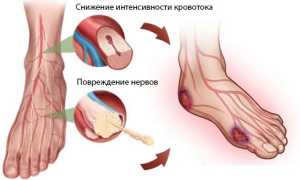 Что такое диабетическая стопа?