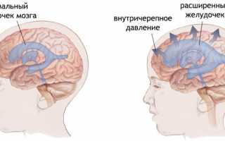 Какой бывает головная боль при давлении