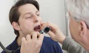 Пробки на гландах: причины и лечение