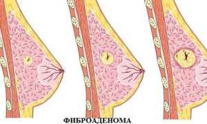 Фиброаденома молочной железы