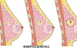 Фиброаденома молочной железы