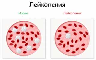 Заболевание лейкопения — что это такое, его проявления