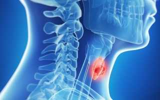 Гипотиреоз при аутоиммунном тиреоидите