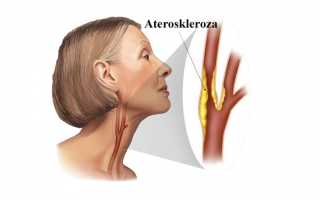 Бомба замедленного действия — холестериновые бляшки в сонной артерии
