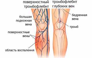 Нетрадиционные методы лечения тромбофлебита