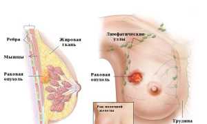 Народные средства от рака молочной железы