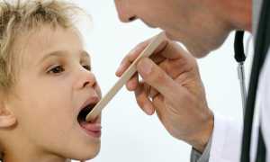 Белый налет на гландах у ребенка