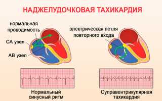 Внезапная наджелудочковая тахикардия: как попытаться купировать приступ, что назначат врачи?