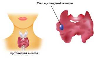 Коллоидные узлы щитовидной железы