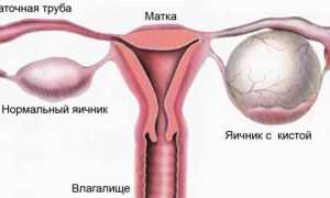 Сидром склерокистозных яичников
