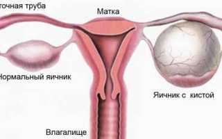 Сидром склерокистозных яичников