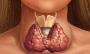 Самые страшные последствия аутоиммунного тиреоидита