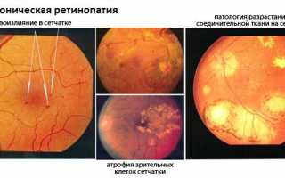 Опасная гипертоническая ретинопатия: первые симптомы, при которых надо срочно к врачу, методы лечения