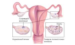 Дермоидная киста яичника