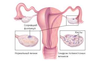 Дермоидная киста яичника