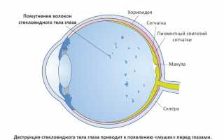 Регулярно стали появляться мушки перед глазами: причины, решение проблемы