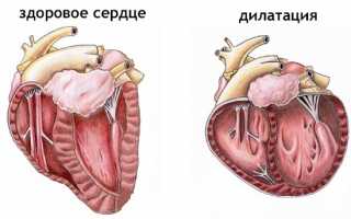 Почему возникает и как лечится дилатация сердца