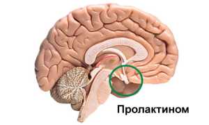Пролактинома гипофиза