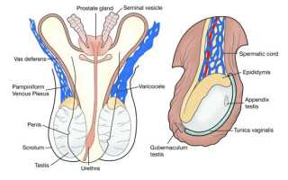 Как лечить варикоцеле в домашних условиях?