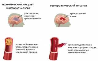 Стремительный и практически неизлечимый геморрагический инсульт головного мозга