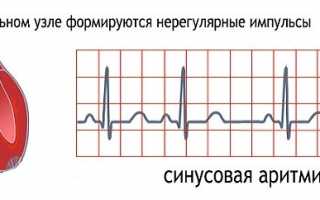 Опасен или нет нестабильный синусовый ритм?