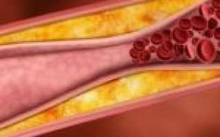 Крайне опасная окклюзия бедренной артерии: срочные меры помощи для спасения конечности