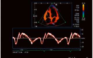 Как проводится и о чем расскажет допплеровская эхокардиография