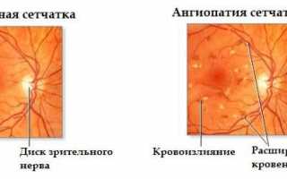 Причины возникновения и лечение ангиопатии глаз у ребенка