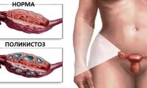 Мультифолликулярные яичники и беременность