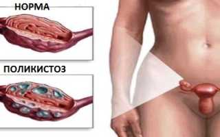 Мультифолликулярные яичники и беременность