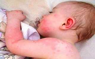 Причины возникновения атопического дерматита у детей: фото, стадии и методы лечения заболевания