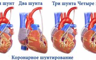 Закупорка венечной артерии или коронарная окклюзия: симптомы, диагностика, лечение