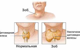 Народное лечение зоба