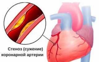 Как принимать нитроглицерин при стенокардии, его аналоги