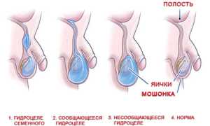 Водянка яичек у новорожденных