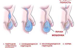 Водянка яичек у новорожденных