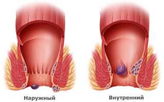 Как выявляется и лечится тромбофлебит геморроидальных вен