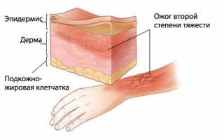 У пациента выявлена гиповолемия: лечение и восстановление состояния