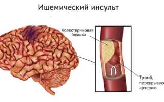 Грозные предвестники инсульта: что стоит знать, чтобы не упустить драгоценное время для обращения за помощью