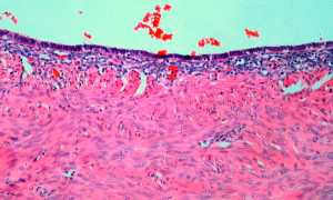 Лечение эндометриоза без гормонов