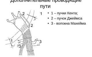 Неприятная особенность организма — дополнительные проводящие пути