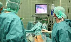 Лапароскопия кисты яичника