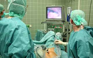 Лапароскопия кисты яичника